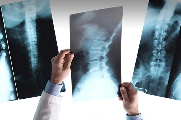 Spinal-Cord-Injuries